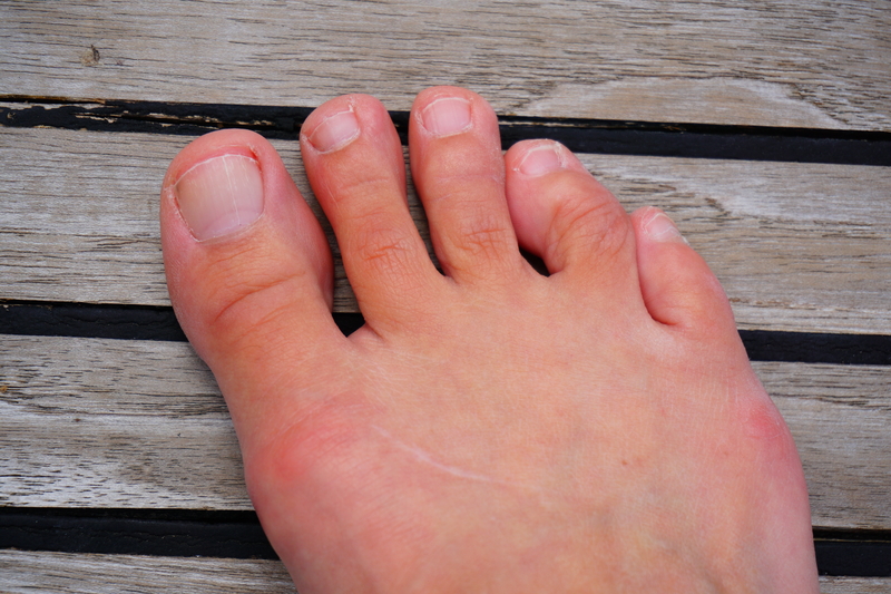 What Are Hammer Toes?